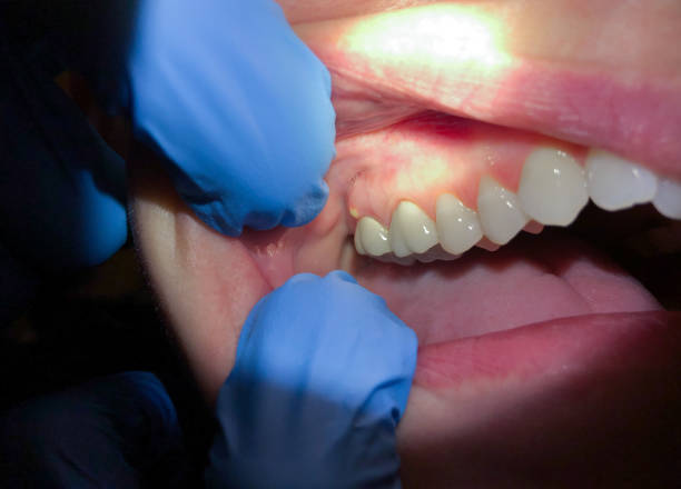 Best After-Hours Emergency Dentist in Calcium, NY